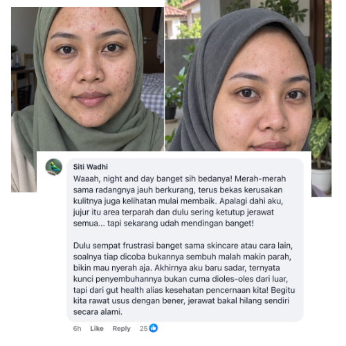 Indonesian woman acne before and after