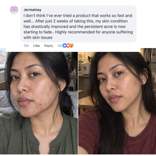 Indonesian woman acne before and after