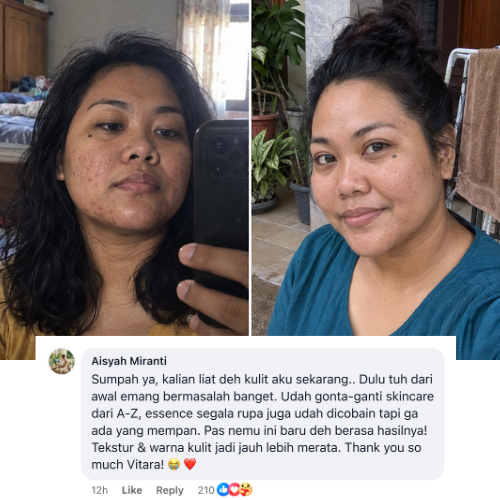 Indonesian woman acne before and after